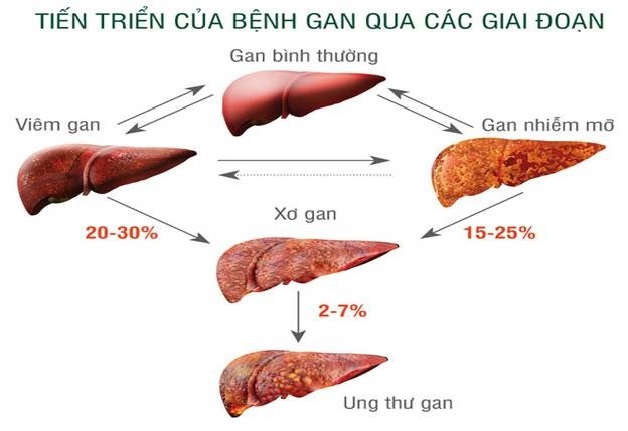 Gan nhiễm mỡ có nguy hiểm không và cách xử lý kịp thời