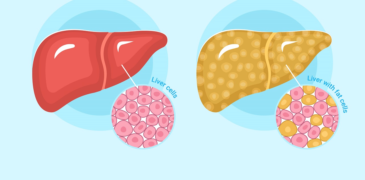 Gan nhiễm mỡ có tác hại gì và cách kiểm soát