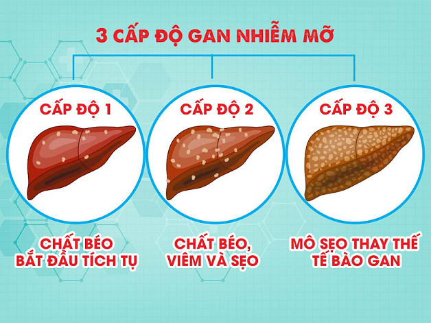 Gan nhiễm mỡ độ 1 có nguy hiểm không? Cách điều trị