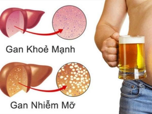 Gan nhiễm mỡ độ 3