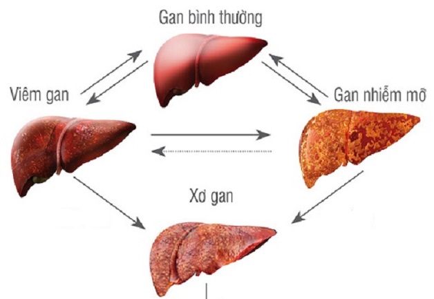 Gan nhiễm mỡ gây xơ gan: Tìm hiểu để phòng tránh!