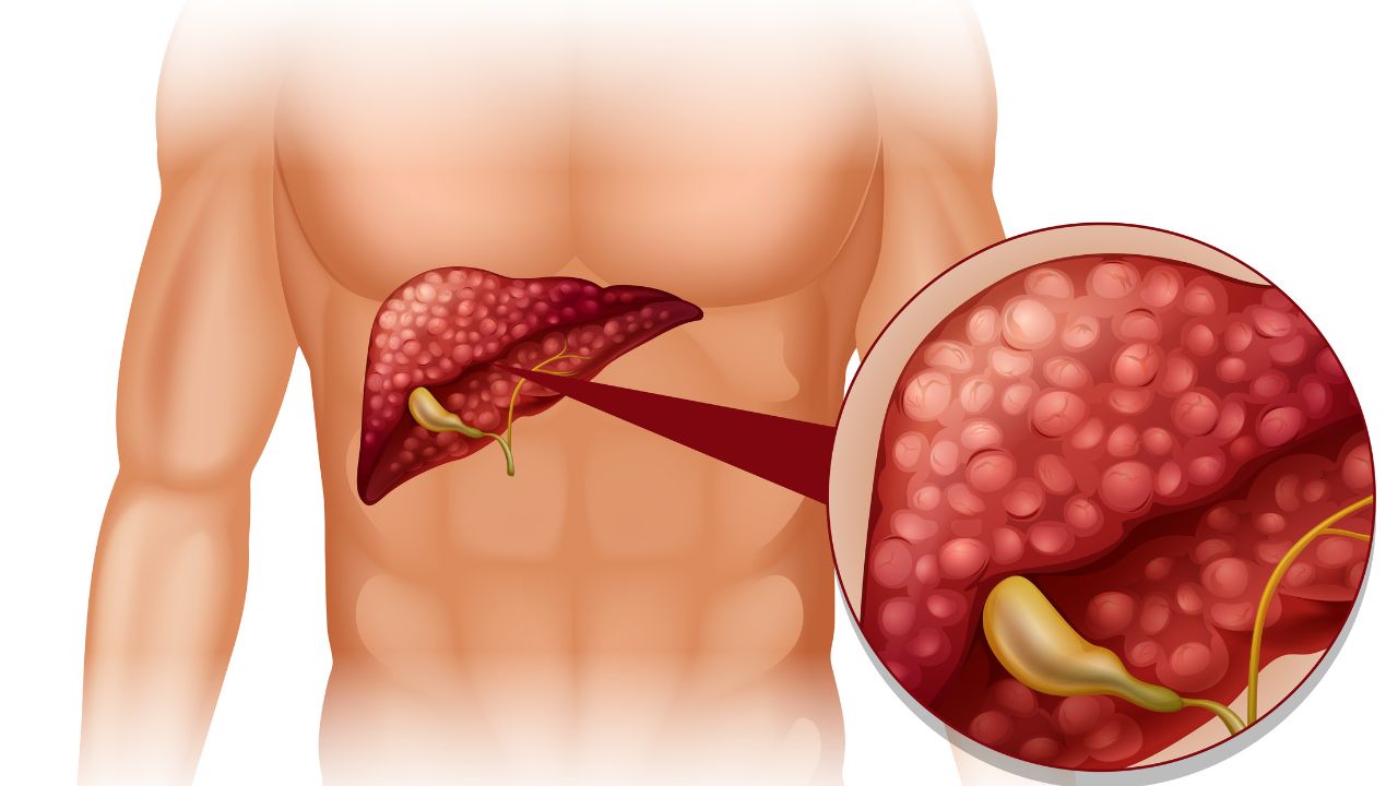 Gan nhiễm mỡ không do rượu: Nguyên nhân và cách chẩn đoán