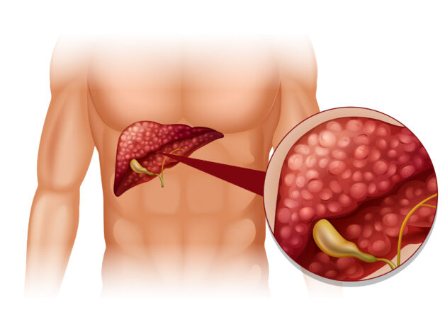 Gan nhiễm mỡ không do rượu: Nguyên nhân và cách chẩn đoán