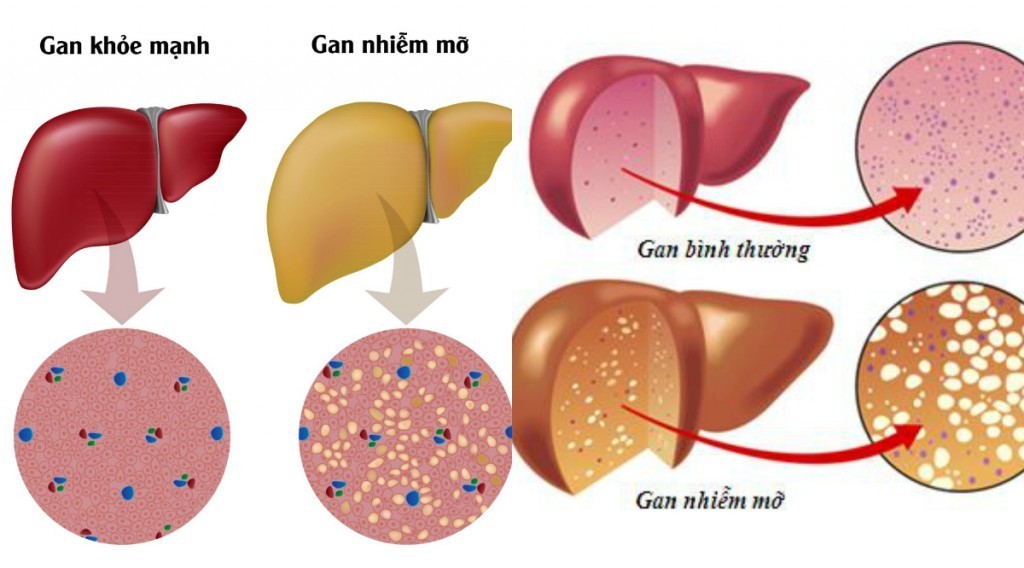 Gan nhiễm mỡ kiêng ăn gì? người bệnh gan nhiễm mỡ