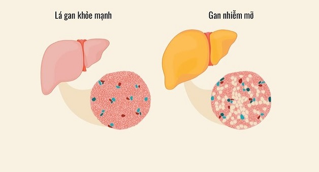 Gan nhiễm mỡ là bệnh gì mà khiến nhiều người lo sợ