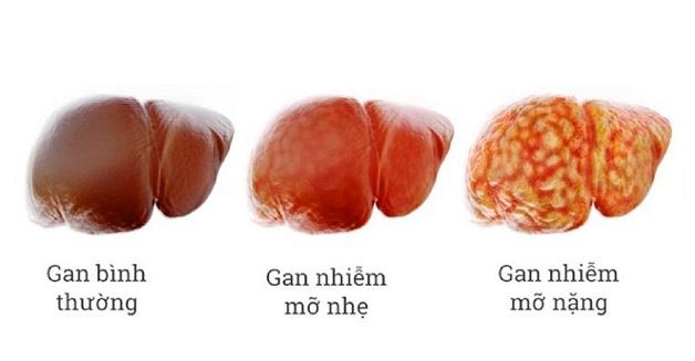 Gan nhiễm mỡ là gì? Cơ chế và nguyên nhân