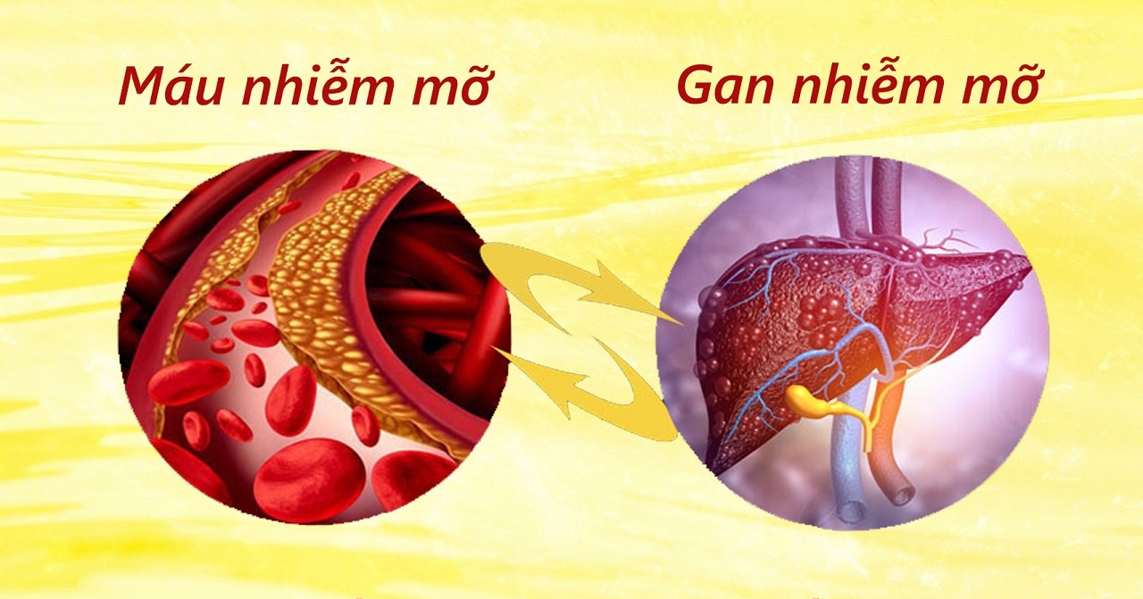 Gan nhiễm mỡ máu nhiễm mỡ và điều cần biết