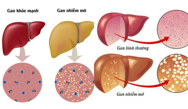 Gan nhiễm mỡ nên uống thuốc gì? Cần lưu ý gì khi dùng thuốc?