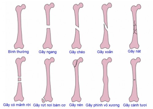 Gãy xương bó bột và những biến chứng nguy hiểm