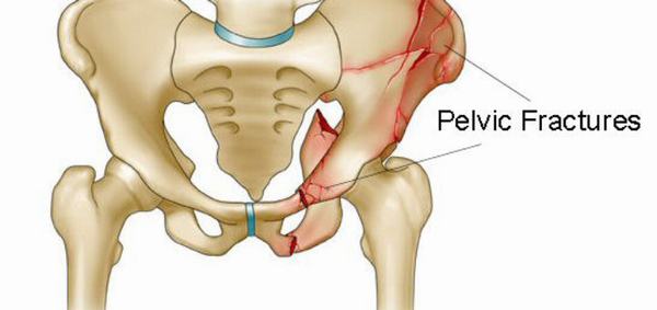 Gãy xương chậu bao lâu thì lành và cần lưu ý gì để nhanh hồi phục?