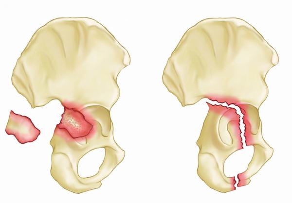 Gãy xương chậu có nguy hiểm không, ảnh hưởng thế nào?