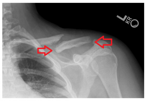 Gãy Xương Đòn Trường Hợp Nào Cần phẫu thuật & Phải Mổ?