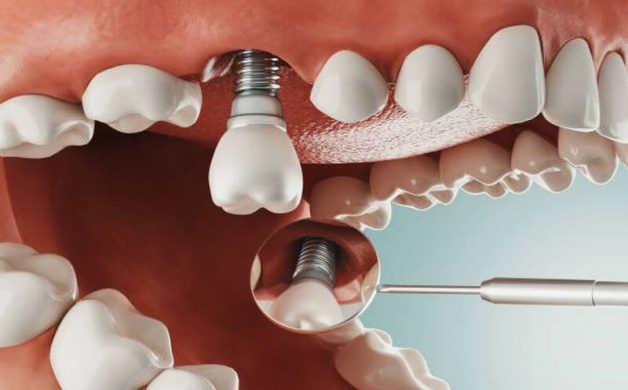 Ghép xương cấy implant có đau không? Cần ghép xương khi nào?