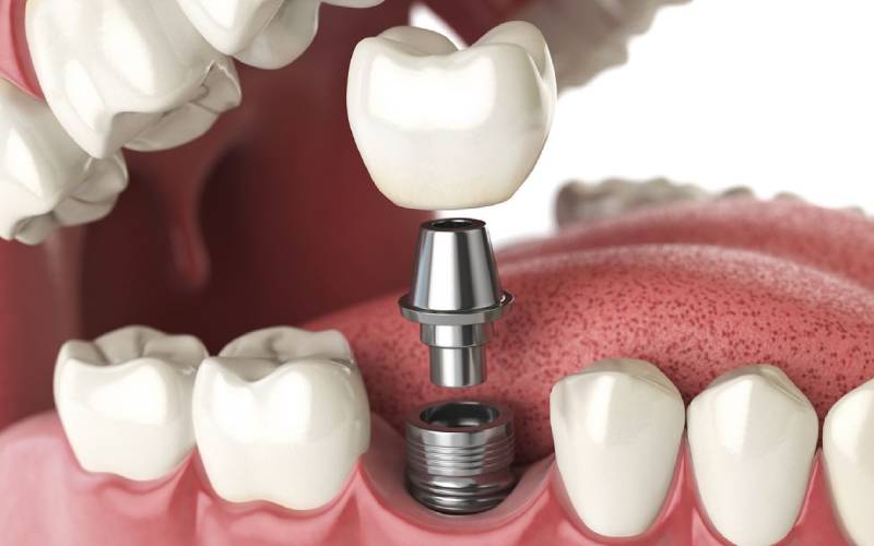 Giá cấy ghép Implant – Cập nhật chi tiết