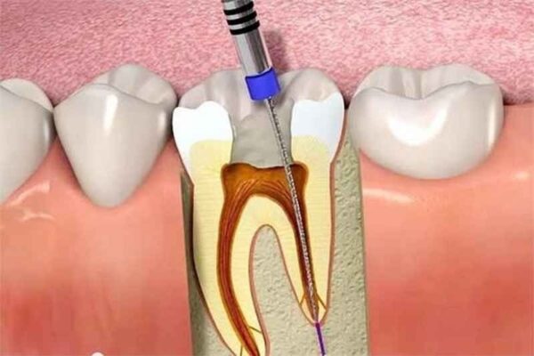 Giá điều trị tủy răng hàm hiện nay