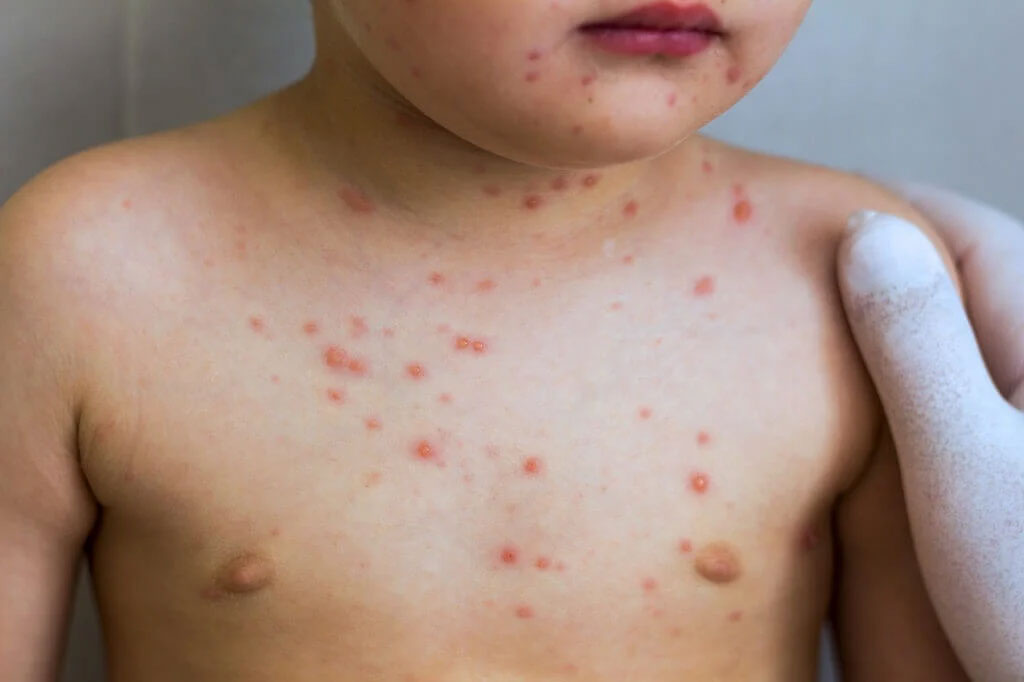 Giá mũi tiêm Rubella cho cả trẻ em và người lớn