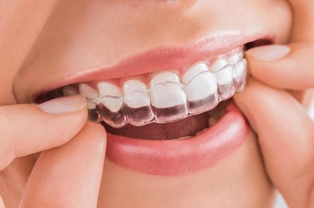 Giá niềng răng Invisalign hiện nay là bao nhiêu? 