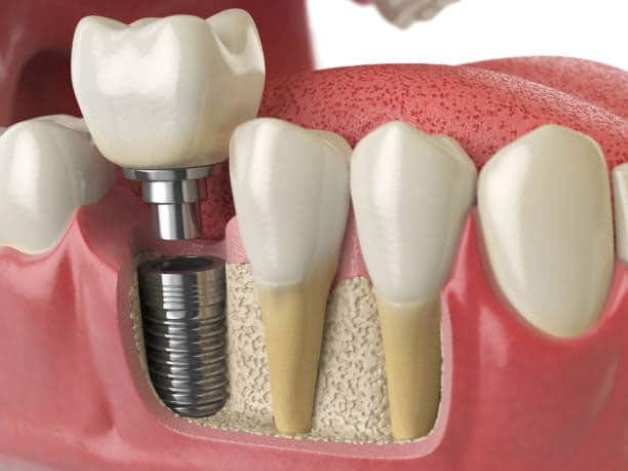 Giá tiền trồng răng implant và các phương pháp thực hiện