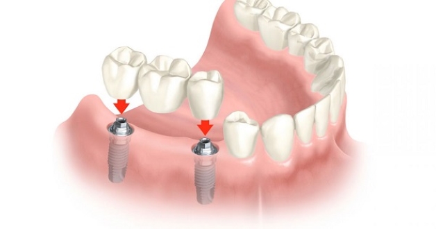 Giá tiền trồng răng implant và các phương pháp thực hiện