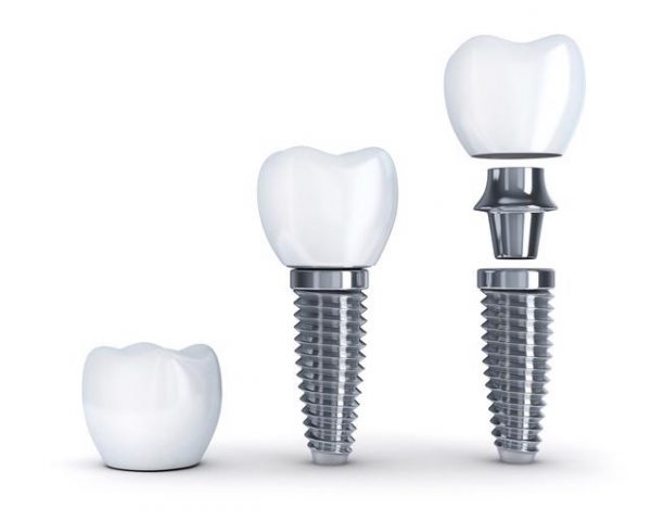 Giá trồng răng Implant Hàn Quốc có cao không?