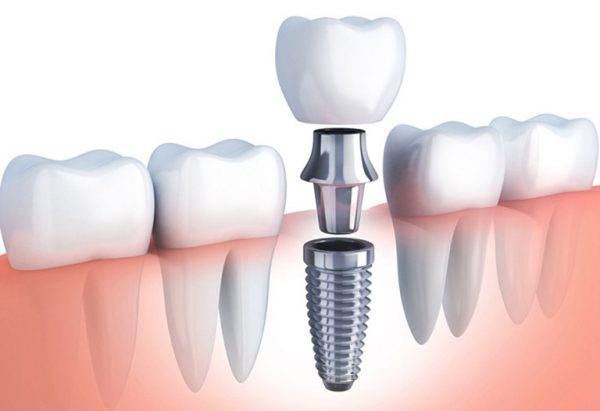 Giá trồng răng Implant Hàn Quốc có cao không?