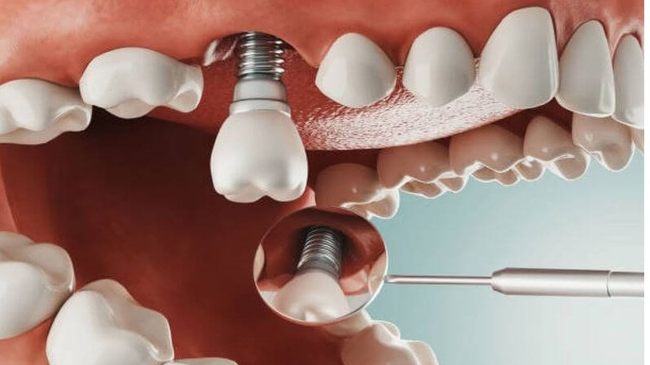 Giá trồng răng implant và những yếu tố liên quan