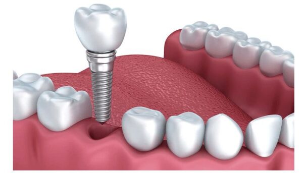 Giá trồng răng implant và những yếu tố liên quan