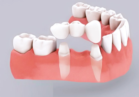 Giá trồng răng sứ có cao không? Nên trồng răng sứ ở đâu tốt?