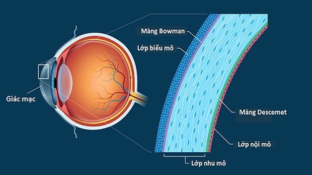 Giác mạc mỏng có phải là bệnh lý?