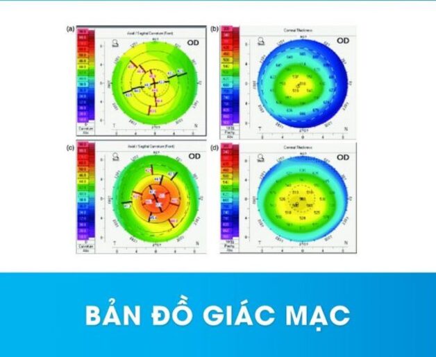 Giác mạc mỏng có phải là bệnh lý?