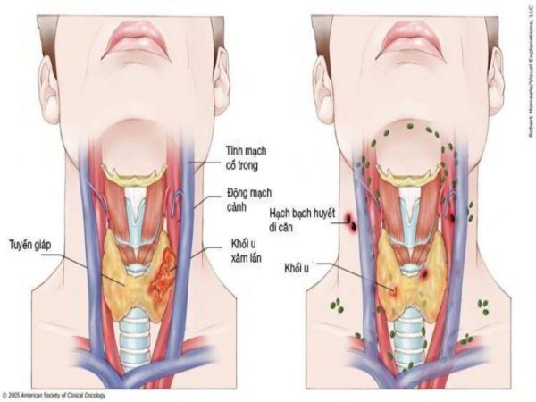 Giải đáp 1001 thắc mắc về vấn đề: Khám tầm soát ung thư