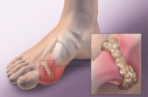 Giải đáp: Bệnh gout có thể chữa khỏi không