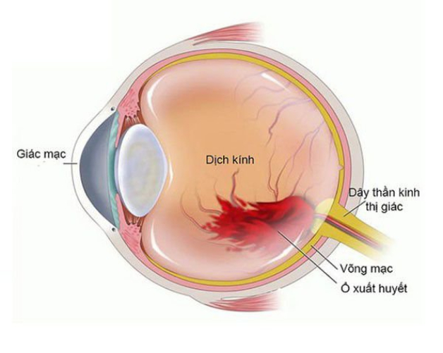 Giải đáp: Bệnh lý xuất huyết dịch kính có hết không?