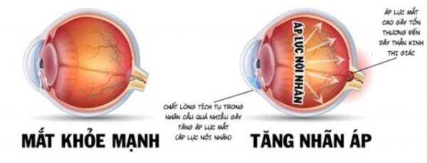 Giải đáp bệnh tăng nhãn áp xử trí thế nào hiệu quả