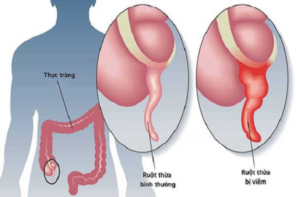 Giải đáp bệnh viêm ruột thừa có nguy hiểm không?