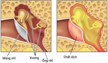 Giải đáp: Bệnh viêm tai giữa thanh dịch ở trẻ nhỏ