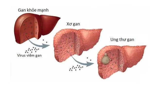 Giải đáp bệnh xơ gan có phải ung thư gan không?