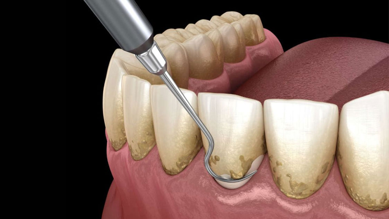 Giải đáp các thắc mắc liên quan đến vấn đề lấy vôi răng