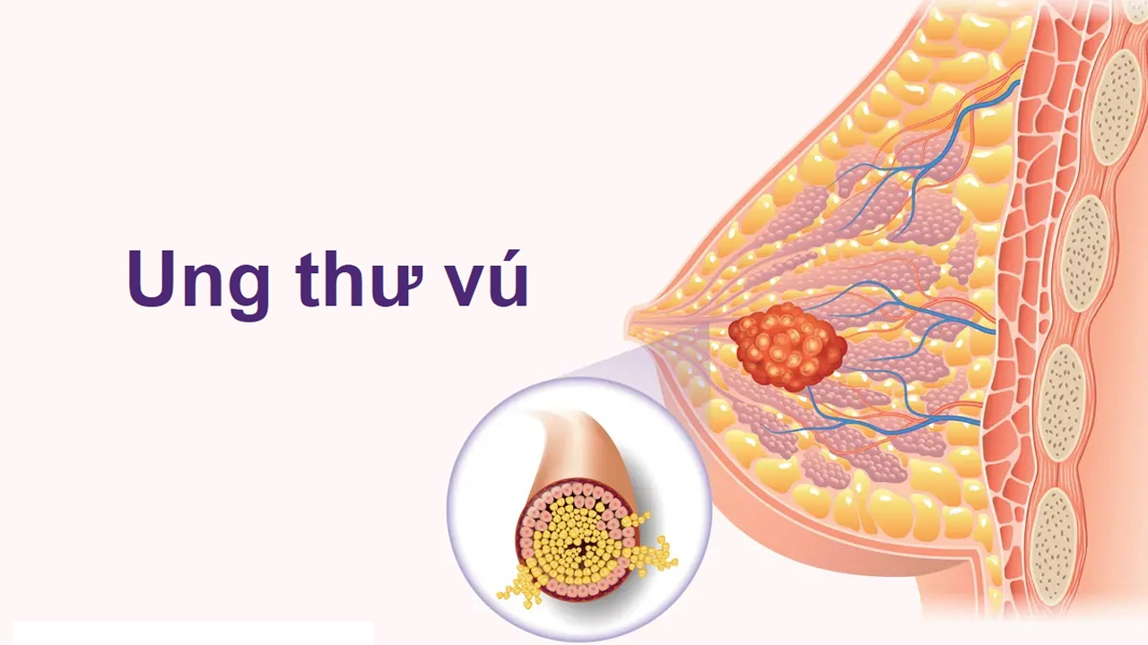 Giải đáp: Carcinoma tuyến vú là gì?