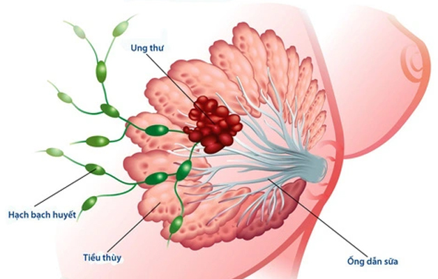 Giải đáp: Carcinoma tuyến vú là gì?