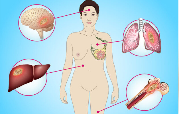 Giải đáp: Carcinoma tuyến vú là gì?