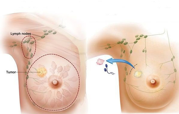 Giải đáp: Carcinoma tuyến vú là gì?