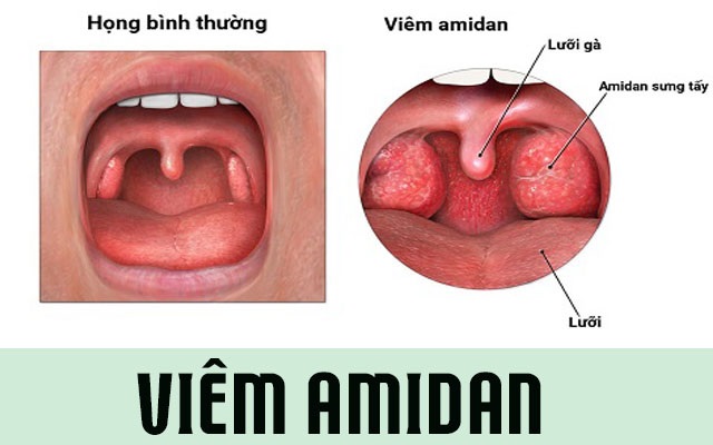 Giải đáp: Cắt amidan chi phí bao nhiêu tiền?