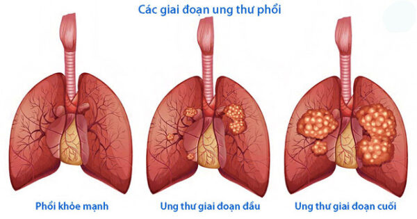 Giải đáp câu hỏi quanh vấn đề giá tầm soát ung thư phổi