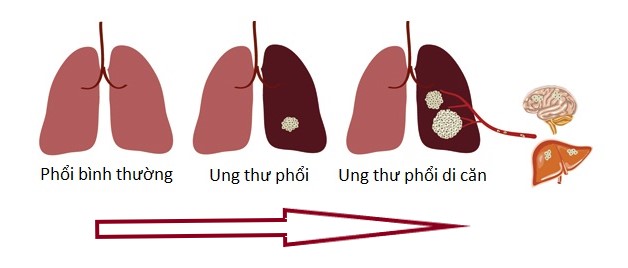 Giải đáp câu hỏi thường gặp về ung thư phổi di căn