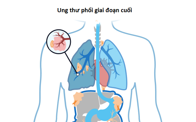 Giải đáp câu hỏi thường gặp về ung thư phổi di căn