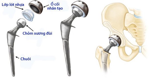 Giải đáp câu hỏi xung quanh việc mổ thay xương khớp háng