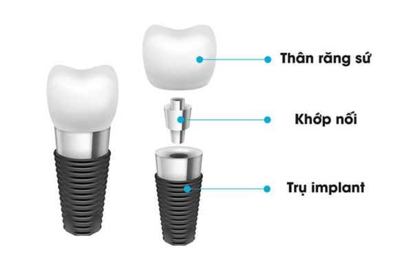 Giải đáp: cấy ghép răng implant bao nhiêu tiền và lưu ý