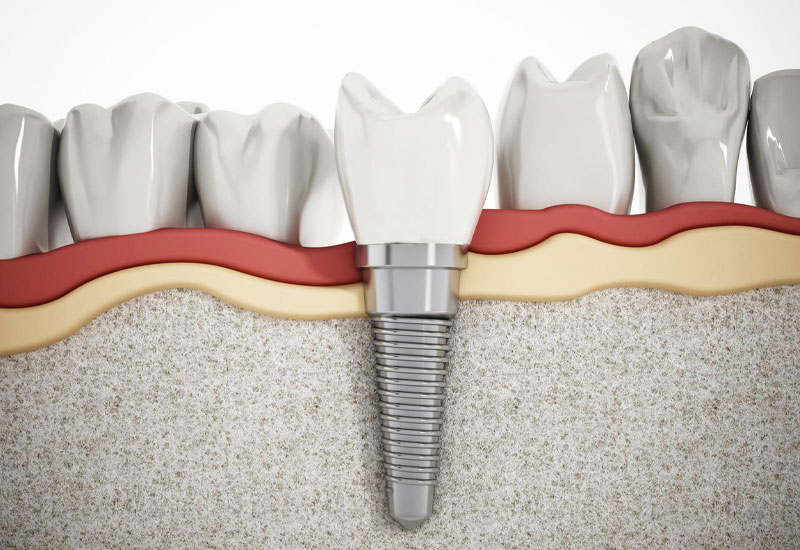 Giải đáp: Cấy ghép răng Implant bao nhiêu tiền