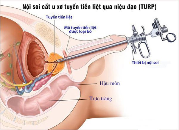 [Giải đáp] Chi phí phẫu thuật u xơ tuyến tiền liệt